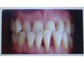 Fotos de Odontoacacías
