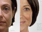 Fotos de Tratamientos Dermatilogico