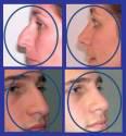 Fotos de Cirugia Estética Y Funcional De La Naríz Dr.ramiro Chavez M.