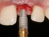 Fotos de Implantes Dentales Oaxaca