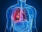 Fotos de Neumologia - Enfermedades Respiratorias